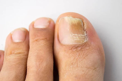 ¿Por qué salen hongos en las uñas de los pies?