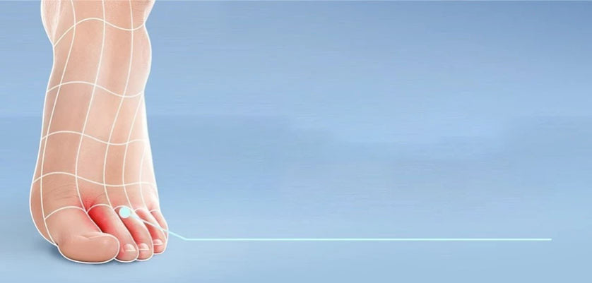 Pie de atleta: síntomas y tratamiento