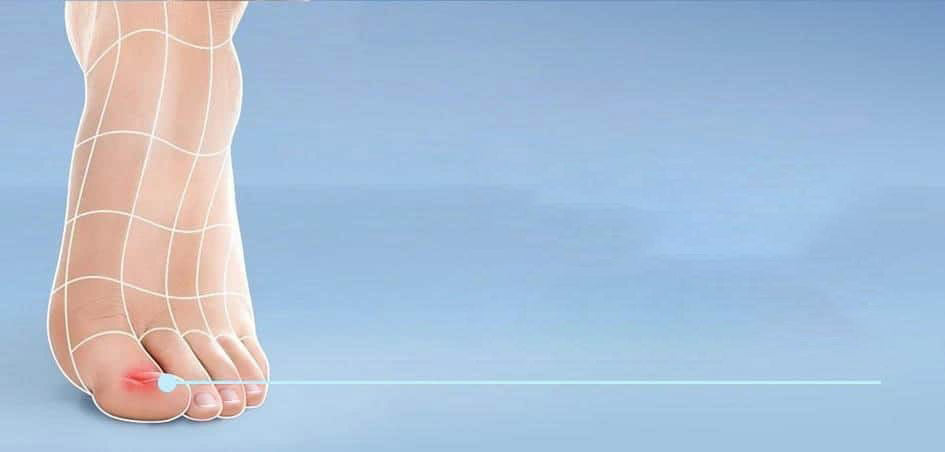 Hongos en las uñas: síntomas, causas y tratamiento