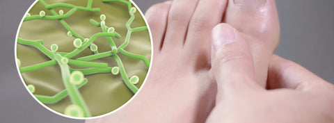 Cómo eliminar los hongos en las uñas de los pies