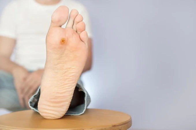 Eliminar verrugas plantares con crioterapia